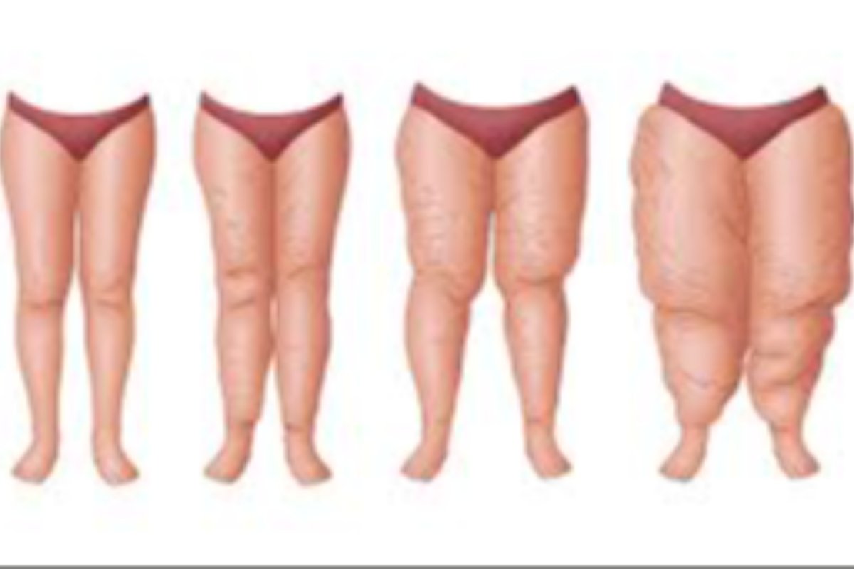 Lipödem nedir? blog resmi