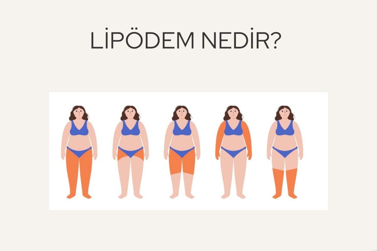 Lipödem Nedir?